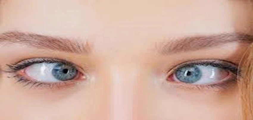 Understanding Squint in the Eye (Strabismus): Causes, Types, Myths, and Treatments