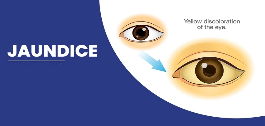 Adult Jaundice: Signs, Symptoms, Prevention, and Treatment