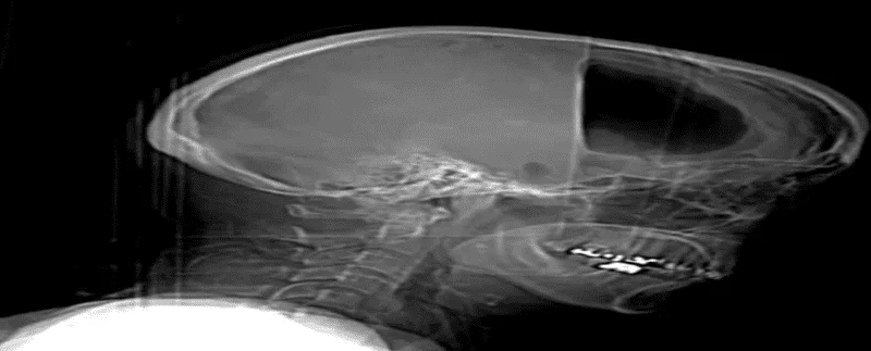 CT scan spiral face