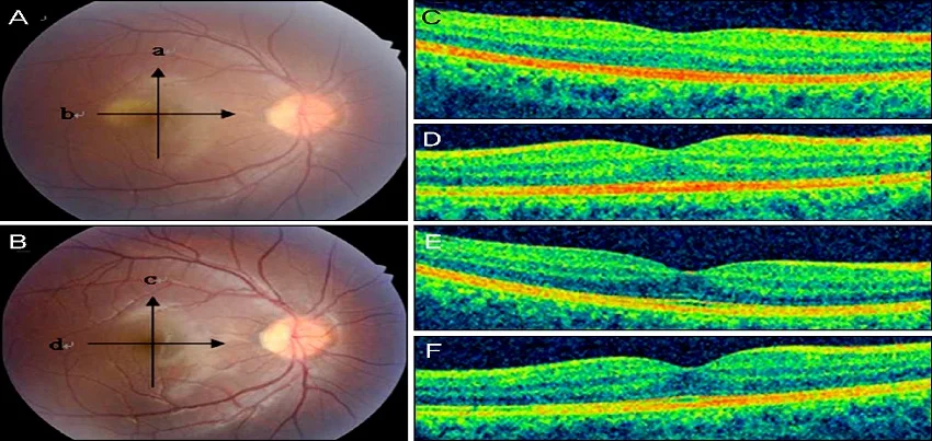Commotio retinae