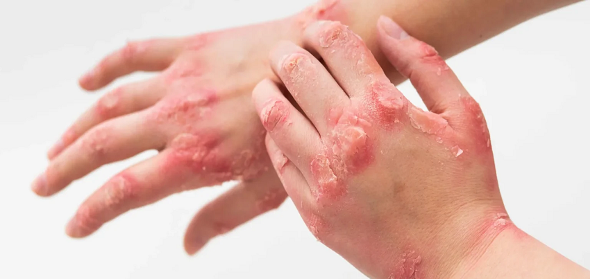 Ichthyosis