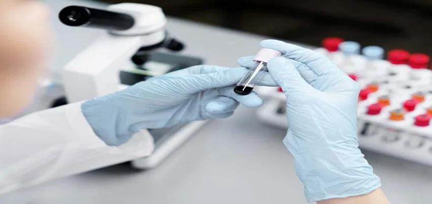 Bilirubin Test