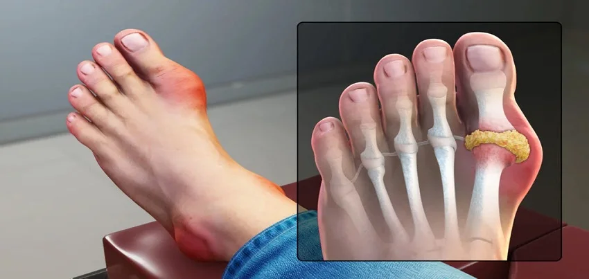 Gout