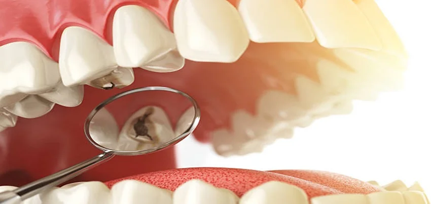 Cavities