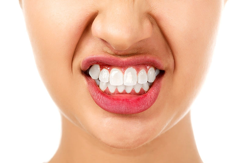 Bruxism (Teeth Grinding)
