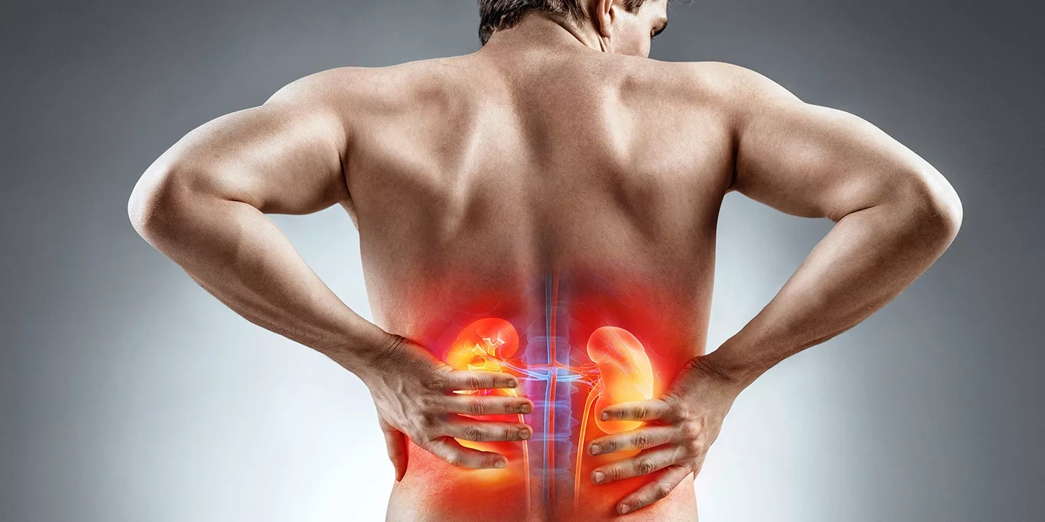 kidney stones