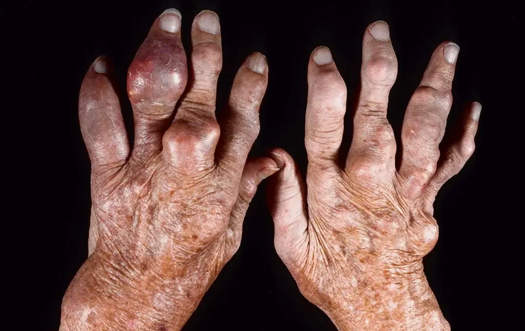 GOUT