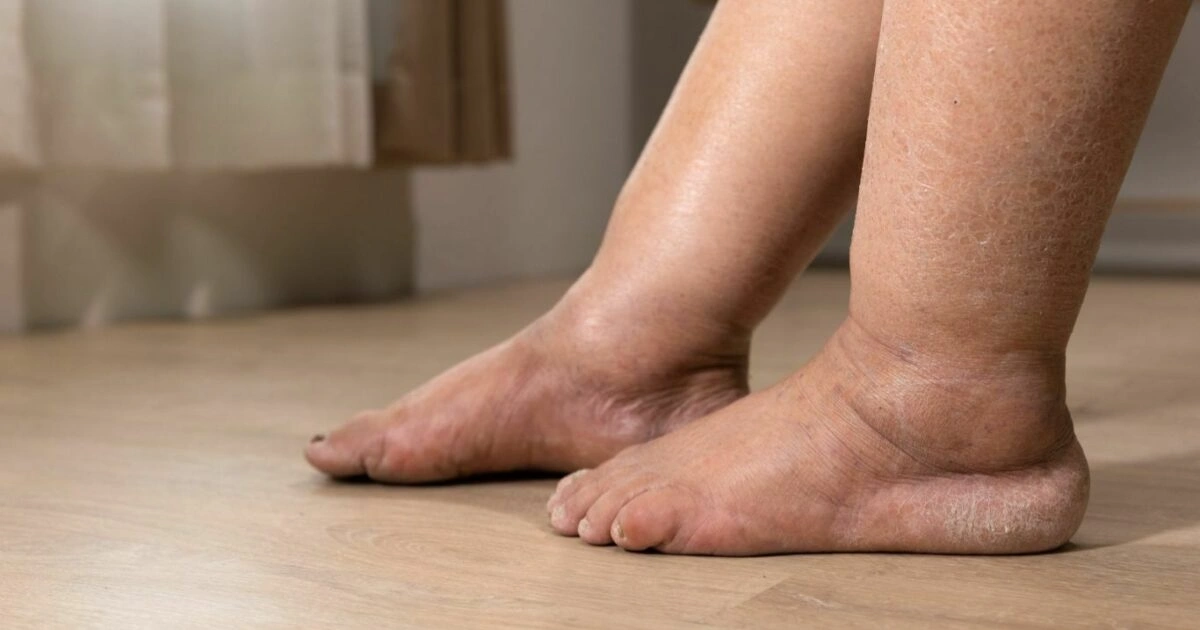 Edema