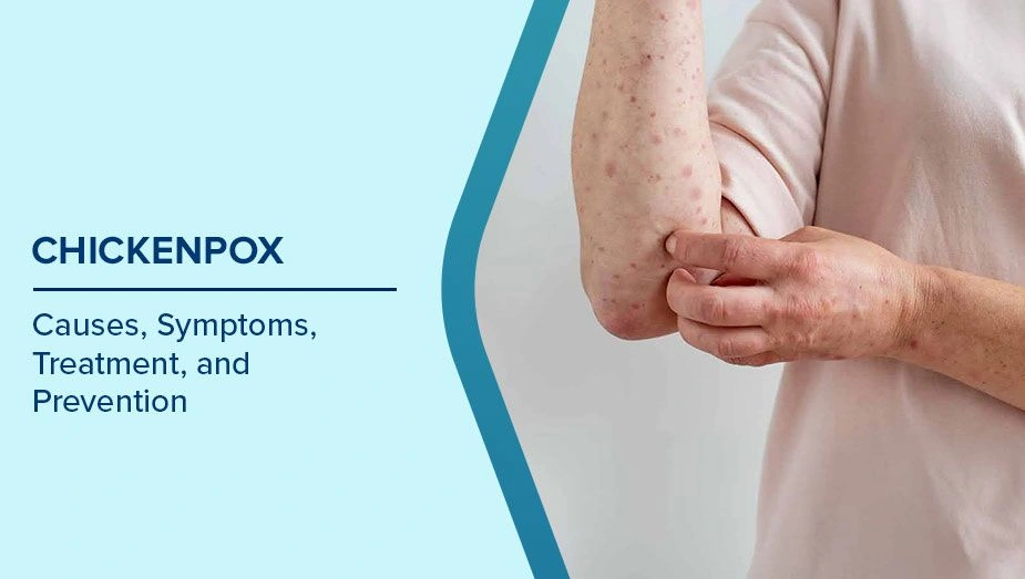 Chickenpox